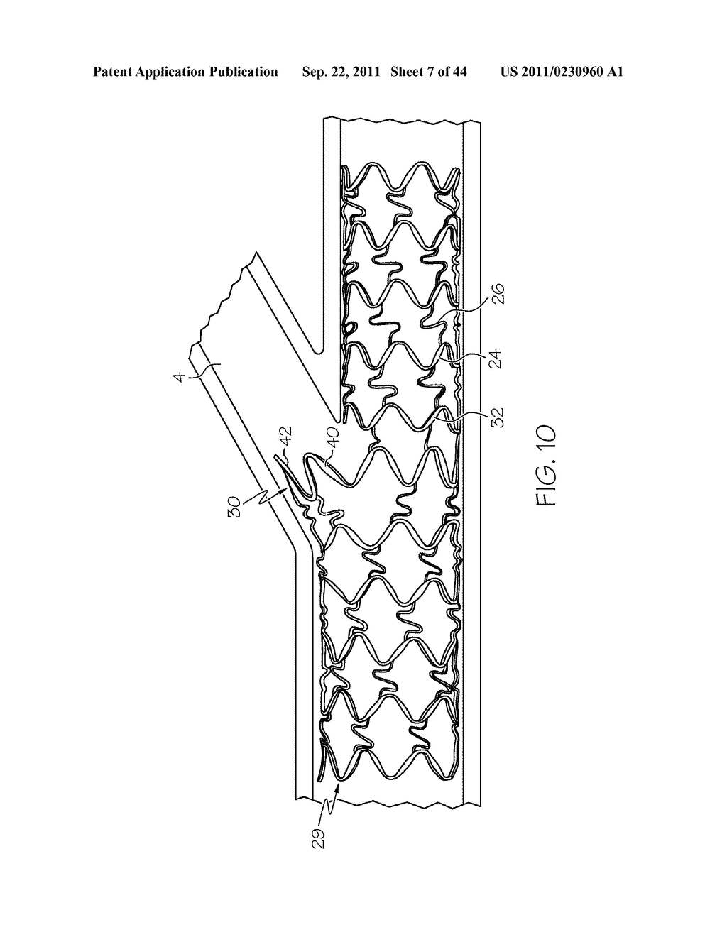 Stent with Protruding Branch Portion for Bifurcated Vessels - diagram, schematic, and image 08