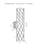 Stent with Protruding Branch Portion for Bifurcated Vessels diagram and image