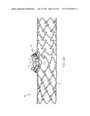 Stent with Protruding Branch Portion for Bifurcated Vessels diagram and image