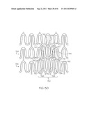 Stent with Protruding Branch Portion for Bifurcated Vessels diagram and image