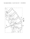 PERCUTANEOUS ARTHRODESIS METHOD AND SYSTEM diagram and image