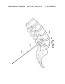 PERCUTANEOUS ARTHRODESIS METHOD AND SYSTEM diagram and image