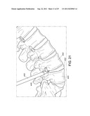 PERCUTANEOUS ARTHRODESIS METHOD AND SYSTEM diagram and image