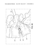 PERCUTANEOUS ARTHRODESIS METHOD AND SYSTEM diagram and image