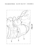 PERCUTANEOUS ARTHRODESIS METHOD AND SYSTEM diagram and image