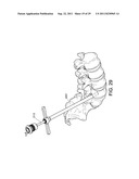 PERCUTANEOUS ARTHRODESIS METHOD AND SYSTEM diagram and image