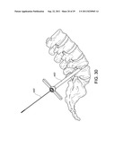 PERCUTANEOUS ARTHRODESIS METHOD AND SYSTEM diagram and image