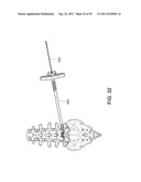 PERCUTANEOUS ARTHRODESIS METHOD AND SYSTEM diagram and image