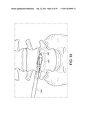 PERCUTANEOUS ARTHRODESIS METHOD AND SYSTEM diagram and image