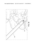 PERCUTANEOUS ARTHRODESIS METHOD AND SYSTEM diagram and image