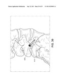 PERCUTANEOUS ARTHRODESIS METHOD AND SYSTEM diagram and image