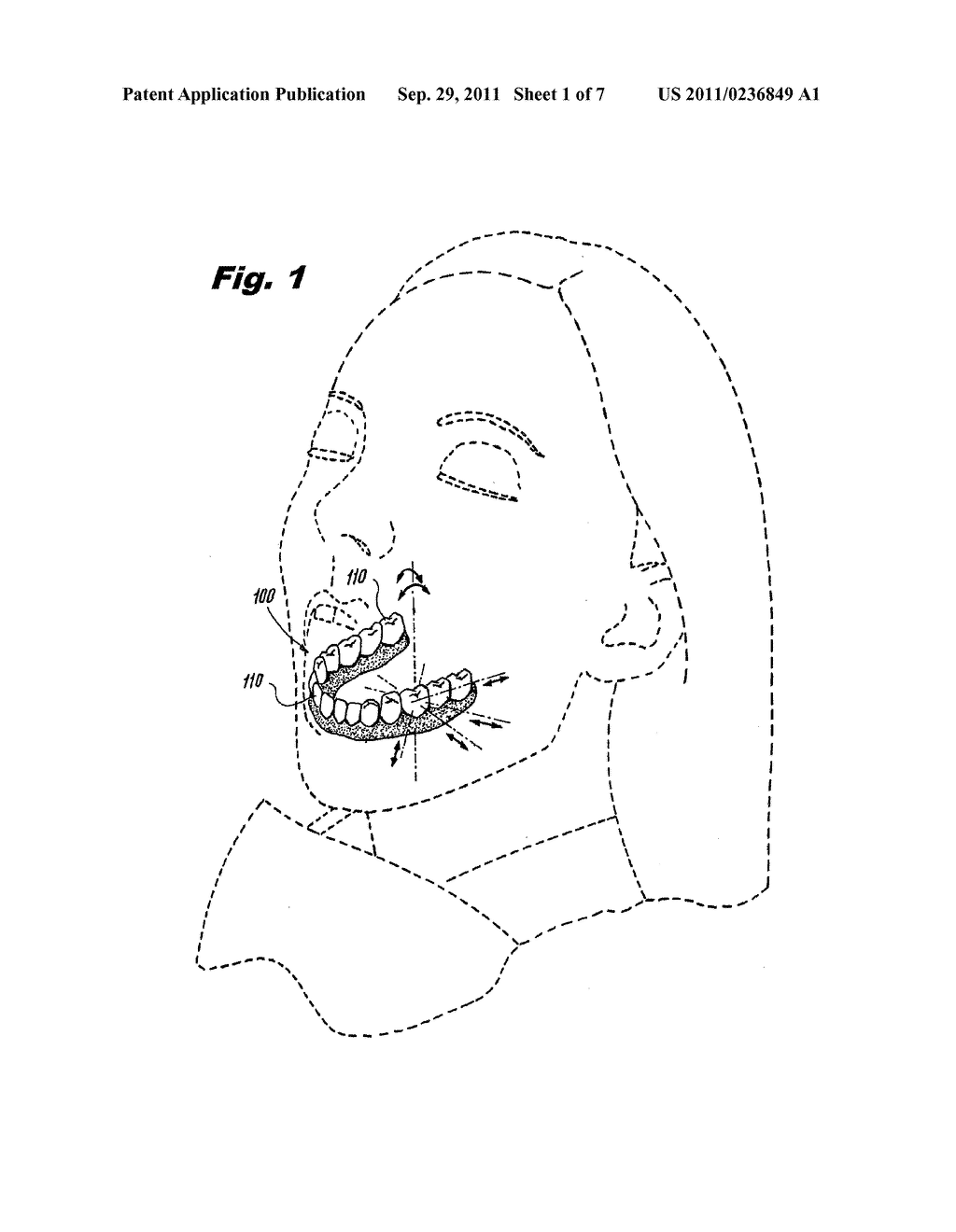 SYSTEM AND METHOD FOR INCREMENTALLY MOVING TEETH - diagram, schematic, and image 02