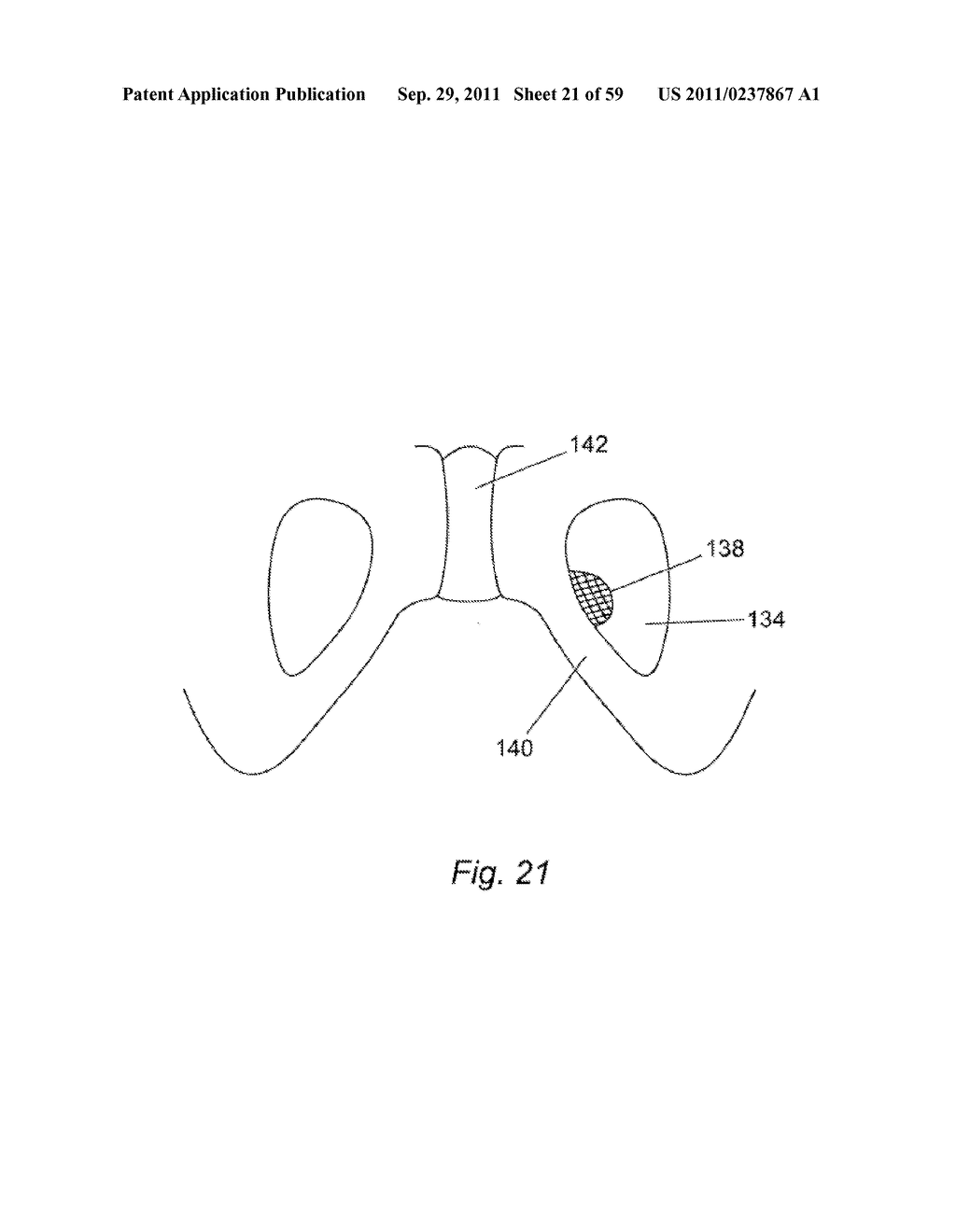 SYSTEM FOR INTRODUCING A PELVIC IMPLANT - diagram, schematic, and image 22