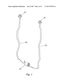 METHOD FOR IMPLANTING WITH AN ANCHOR INTRODUCER CHANNEL diagram and image