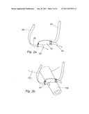 METHOD FOR IMPLANTING WITH AN ANCHOR INTRODUCER CHANNEL diagram and image