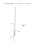 METHOD FOR IMPLANTING WITH AN ANCHOR INTRODUCER CHANNEL diagram and image