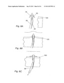 METHOD FOR IMPLANTING WITH AN ANCHOR INTRODUCER CHANNEL diagram and image