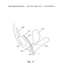 METHOD FOR IMPLANTING WITH AN ANCHOR INTRODUCER CHANNEL diagram and image