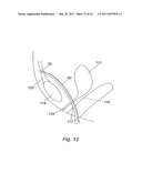 METHOD FOR IMPLANTING WITH AN ANCHOR INTRODUCER CHANNEL diagram and image