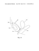 METHOD FOR IMPLANTING WITH AN ANCHOR INTRODUCER CHANNEL diagram and image