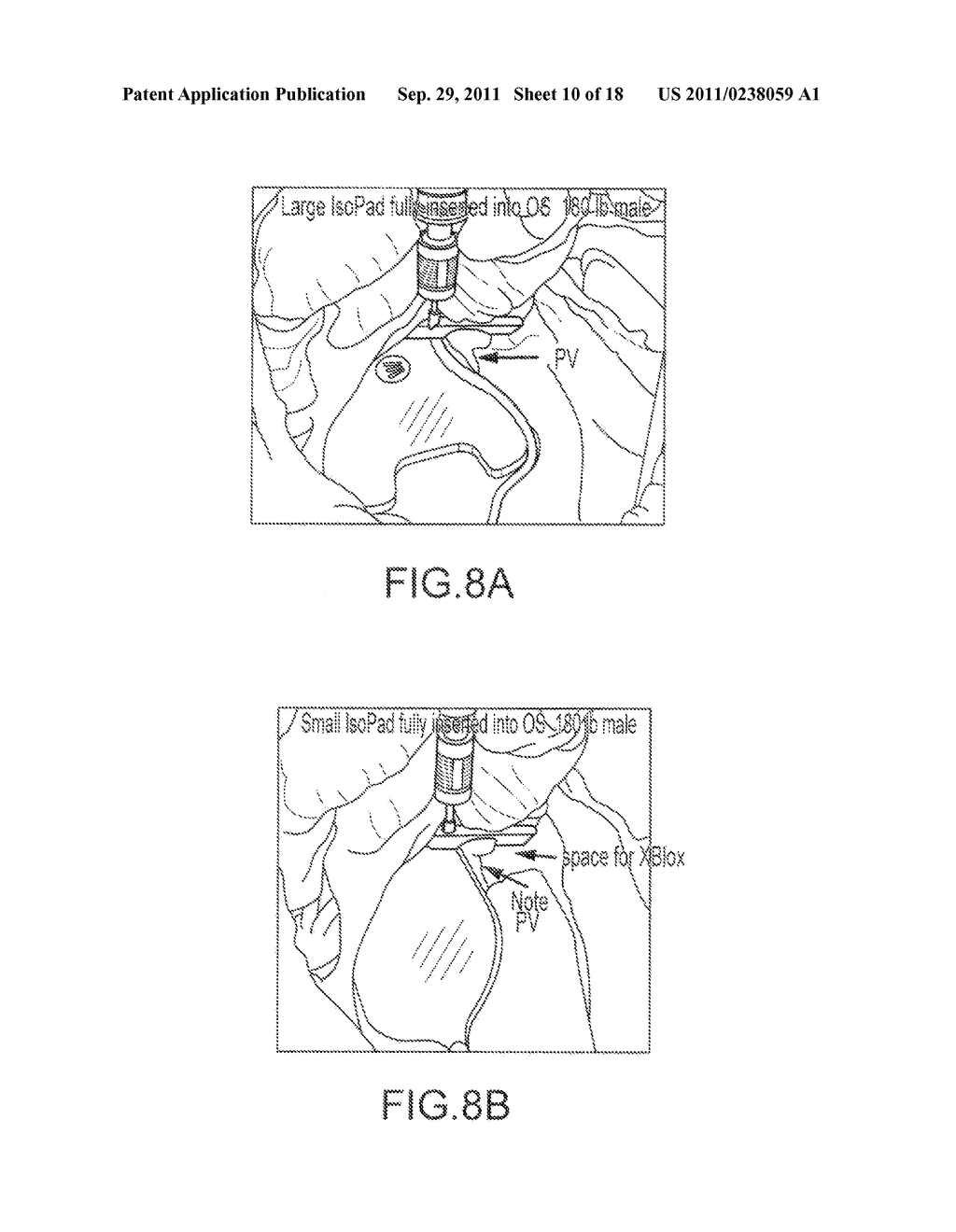 PROTECTIVE SYSTEMS AND METHODS FOR USE DURING ABLATION PROCEDURES - diagram, schematic, and image 11