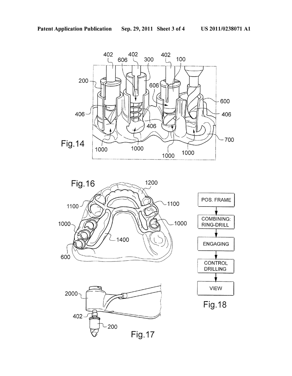 DRILL ASSISTANCE KIT FOR IMPLANT HOLE IN A BONE STRUCTURE - diagram, schematic, and image 04