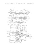 Minimally Invasive Surgical (MIS) Technique and System for Performing an     Interbody Lumbar Fusion with a Navigatable Intervertebral Disc Removal     Device and Collapsible Intervertebral Device diagram and image