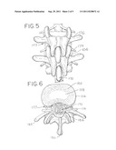 Minimally Invasive Surgical (MIS) Technique and System for Performing an     Interbody Lumbar Fusion with a Navigatable Intervertebral Disc Removal     Device and Collapsible Intervertebral Device diagram and image