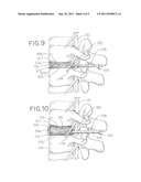 Minimally Invasive Surgical (MIS) Technique and System for Performing an     Interbody Lumbar Fusion with a Navigatable Intervertebral Disc Removal     Device and Collapsible Intervertebral Device diagram and image