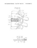 Minimally Invasive Surgical (MIS) Technique and System for Performing an     Interbody Lumbar Fusion with a Navigatable Intervertebral Disc Removal     Device and Collapsible Intervertebral Device diagram and image