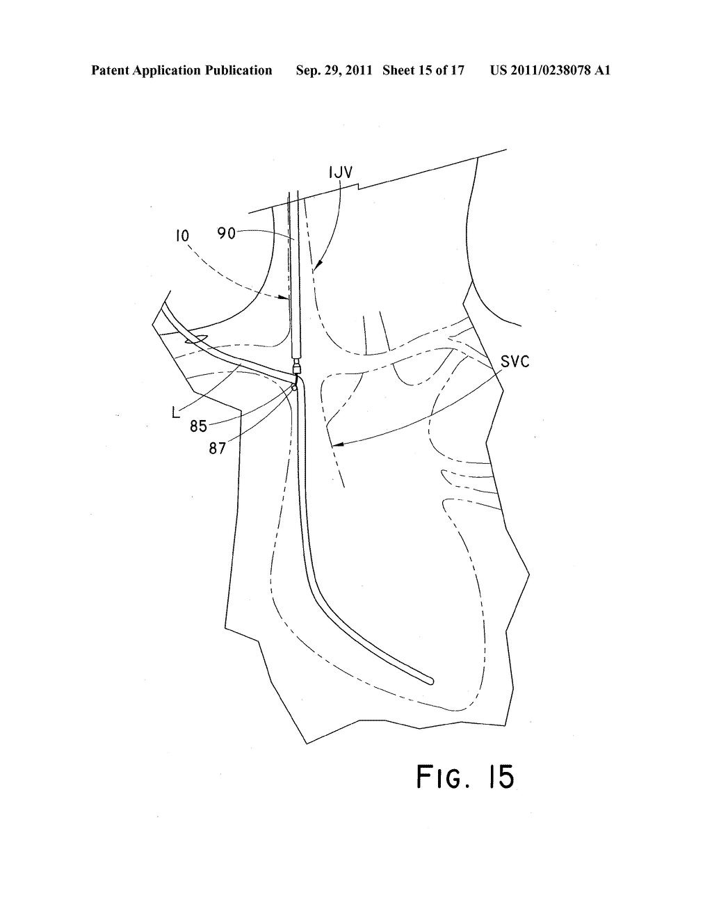 DEVICE AND METHOD FOR POSITIONING AN IMPLANTED STRUCTURE TO FACILITATE     REMOVAL - diagram, schematic, and image 16