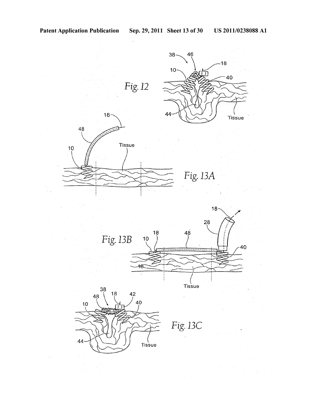 DEVICES, SYSTEMS, AND METHODS FOR SUPPORTING TISSUE AND/OR STRUCTURES     WITHIN A HOLLOW BODY ORGAN - diagram, schematic, and image 14