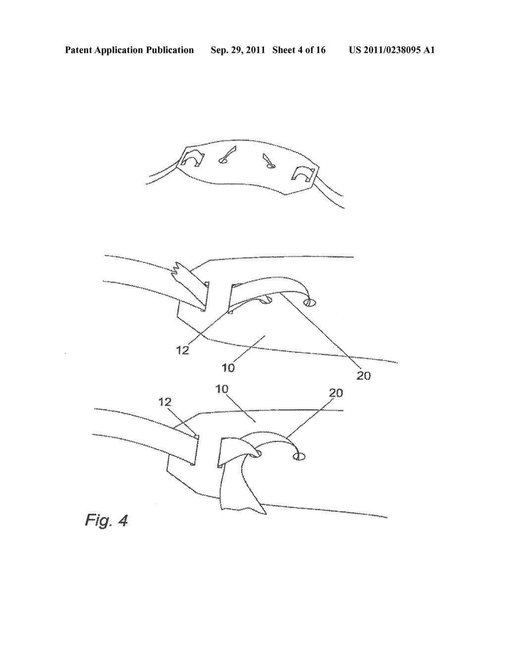 ABSORBABLE ANCHOR AND METHOD FOR MOUNTING MESH TO TISSUE - diagram, schematic, and image 05