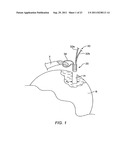 RING CINCH ASSEMBLY TO ATTACH BONE TO TISSUE diagram and image