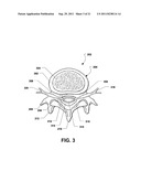 INTERSPINOUS PROCESS BRACE diagram and image