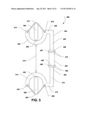 INTERSPINOUS PROCESS BRACE diagram and image