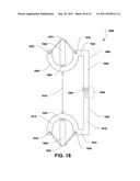 INTERSPINOUS PROCESS BRACE diagram and image