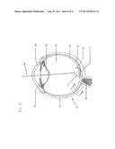 ARTIFICIAL RETINA DEVICE WITH STIMULATING AND GROUND RETURN ELECTRODES     DISPOSED ON OPPOSITE SIDES OF THE NEURORETINA AND METHOD OF ATTACHMENT diagram and image