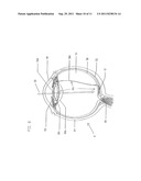 ARTIFICIAL RETINA DEVICE WITH STIMULATING AND GROUND RETURN ELECTRODES     DISPOSED ON OPPOSITE SIDES OF THE NEURORETINA AND METHOD OF ATTACHMENT diagram and image