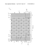 Flexible Stent Design diagram and image