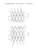 Flexible Stent Design diagram and image