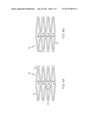 Flexible Stent Design diagram and image