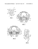 SACRO-ILIAC JOINT IMPLANT SYSTEM AND METHOD diagram and image