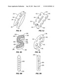 SACRO-ILIAC JOINT IMPLANT SYSTEM AND METHOD diagram and image