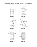 SACRO-ILIAC JOINT IMPLANT SYSTEM AND METHOD diagram and image