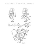 SACRO-ILIAC JOINT IMPLANT SYSTEM AND METHOD diagram and image