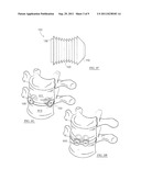 Interbody Fusion Device diagram and image