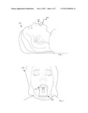 Oral Device For Radiotherapy diagram and image