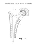 Orthopaedic Component Manufacturing Method and Equipment diagram and image