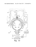 Orthopaedic Component Manufacturing Method and Equipment diagram and image